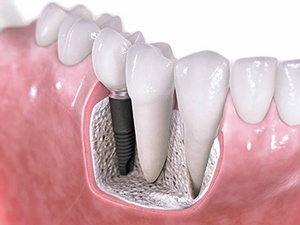 Dental-Implants