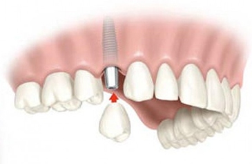 implant-pojedinacni-zub