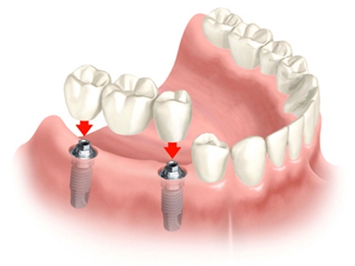 implant-vise-zuba-distalno