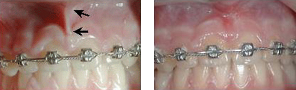 frenulum