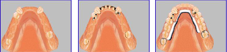 kombinovani-protetski-rad-1